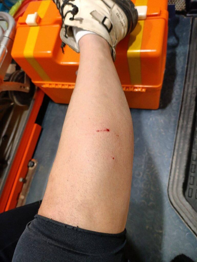 У Луганську на дівчину напала зграя собак. Її госпіталізувли